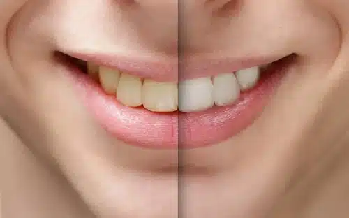 Whitening: 5 Things to Know Before Getting a Brighter Smile