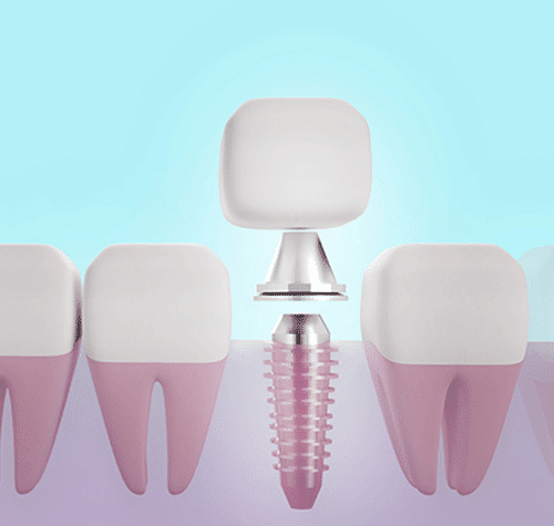 waht are implants