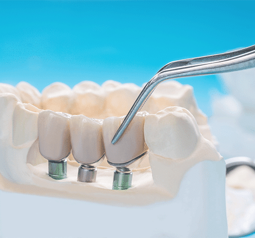 why-dental-implants
