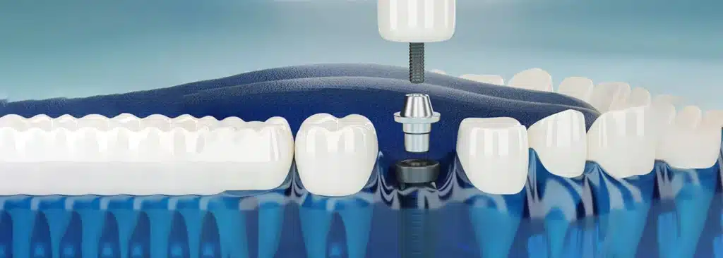 Dental Implants 1 best dental implants in texas